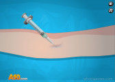 Brain Surgery: Anaesthesia